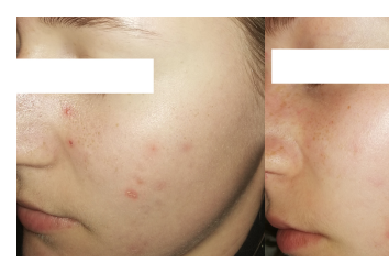 Acne-prone skin - sebum control and lesion reduction