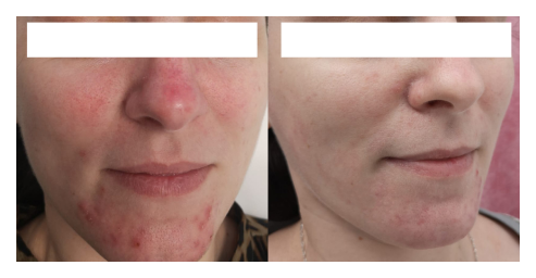 Vascular skin - even tone and improved firmness